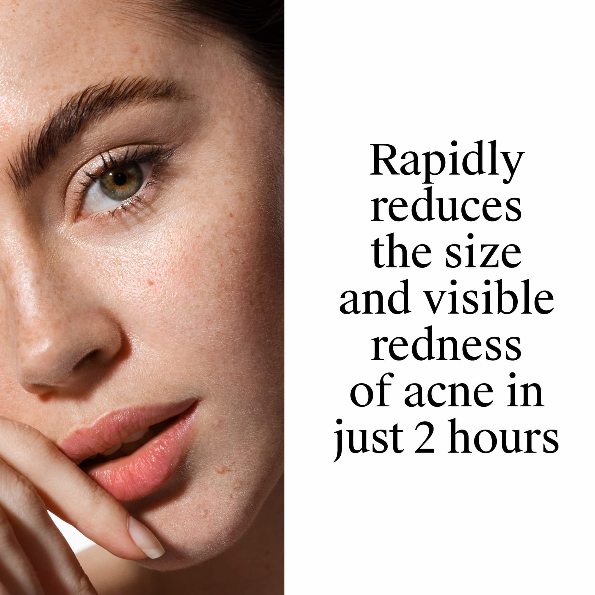 Neutrogena Rapid Clear Acne Spot Treatment, Benzoyl Peroxide 10% Pimple Cream, 1 oz